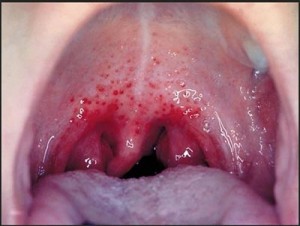 gonorrhea in throat